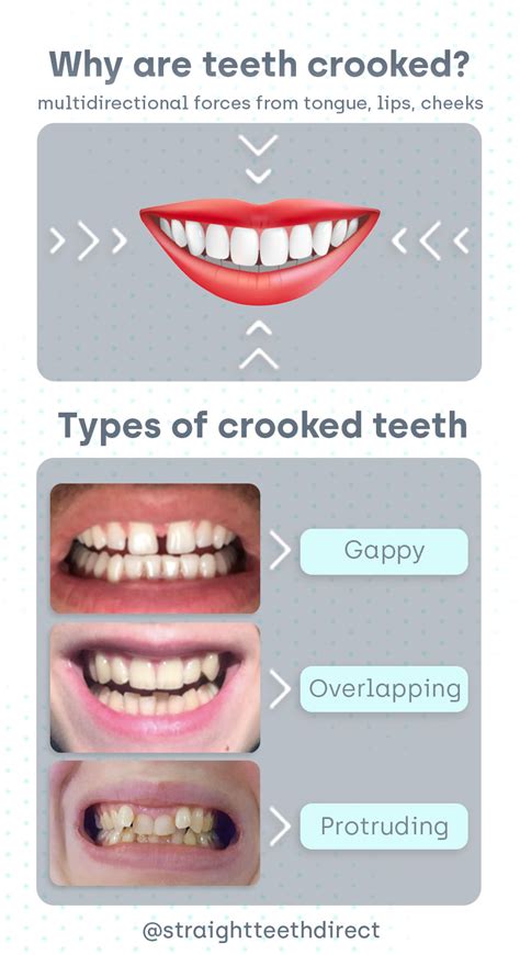 Things to know about crooked or crowded teeth: .